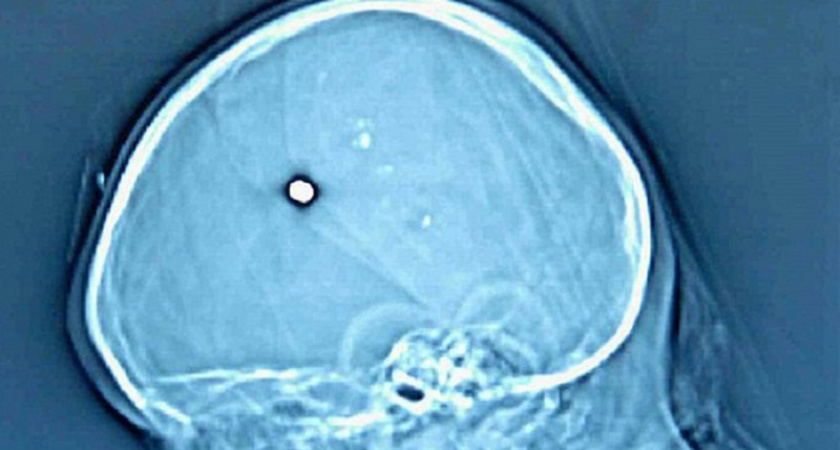 Юный житель Брянской области пять лет ходил с пулей в голове – пока голова всё-таки не заболела